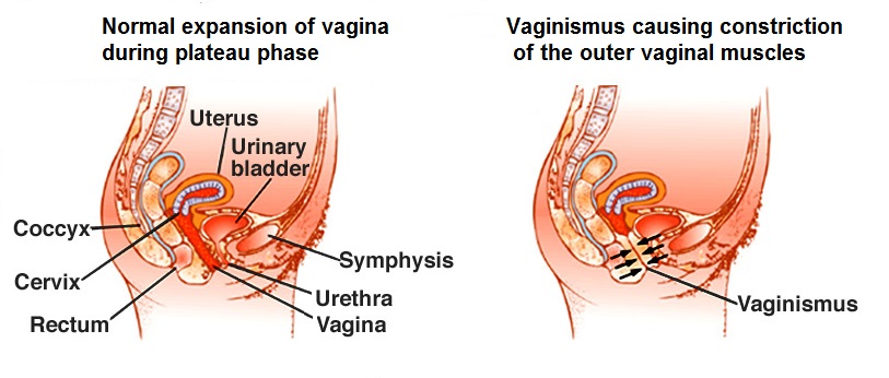 Vaginal Yeast Infection – eMedicineHealth