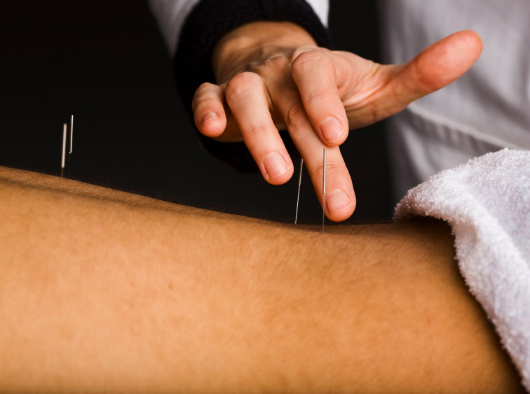 Acupuncture for back pain
