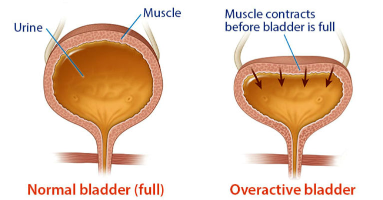 What is overactive Bladder