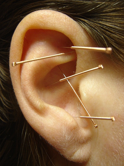 Ear Acupuncture - Auricular Therapy