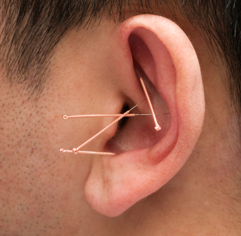 NADA Acupuncture for drug addiction