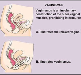 Vaginismus