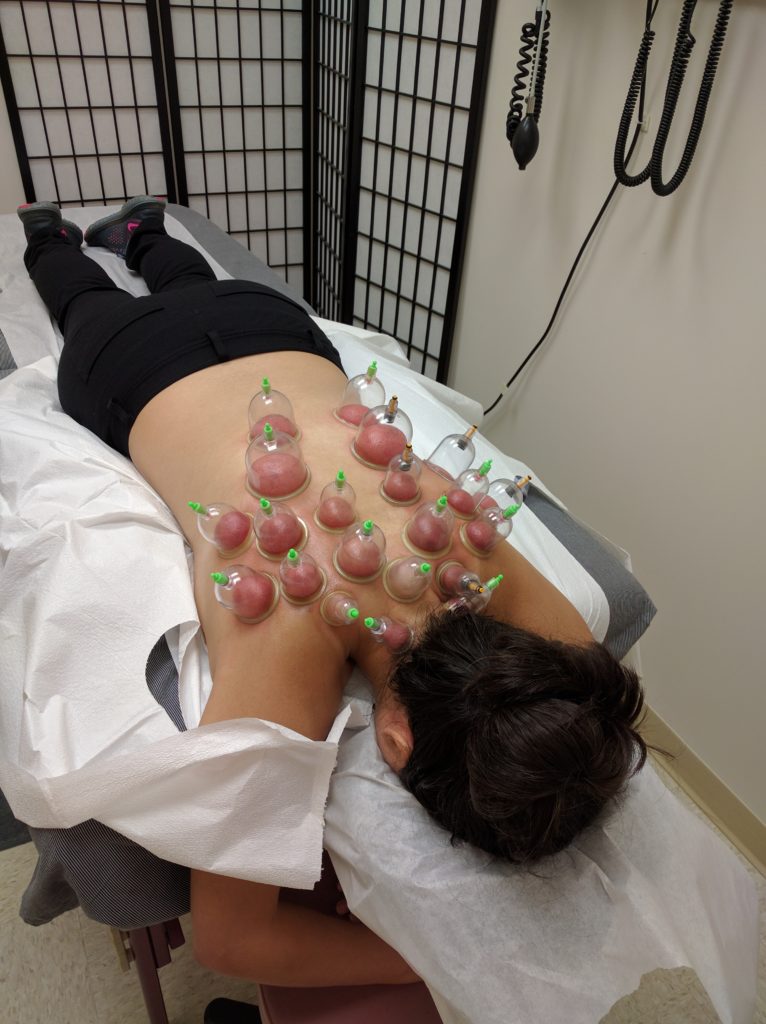 Cupping therapy Philadelphia Acupuncture Clinic As seen on NBC10