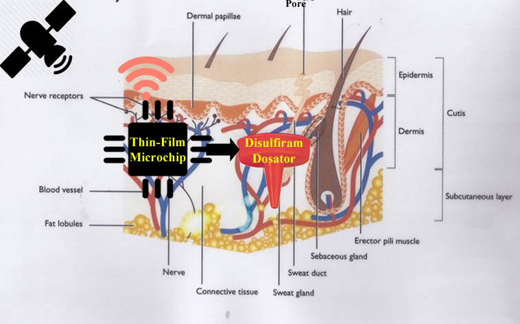 Esperal Implant Network