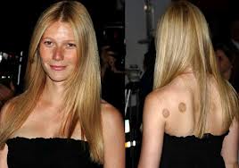 Dry Cupping