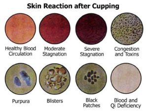 Cupping for Detoxification