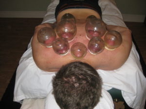 Cupping for back pain