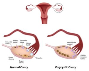 What is PCOS