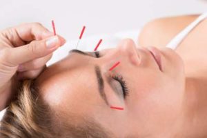 Can Acupuncture Cure Migraines?