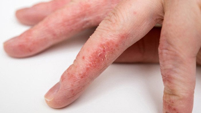 Eczema