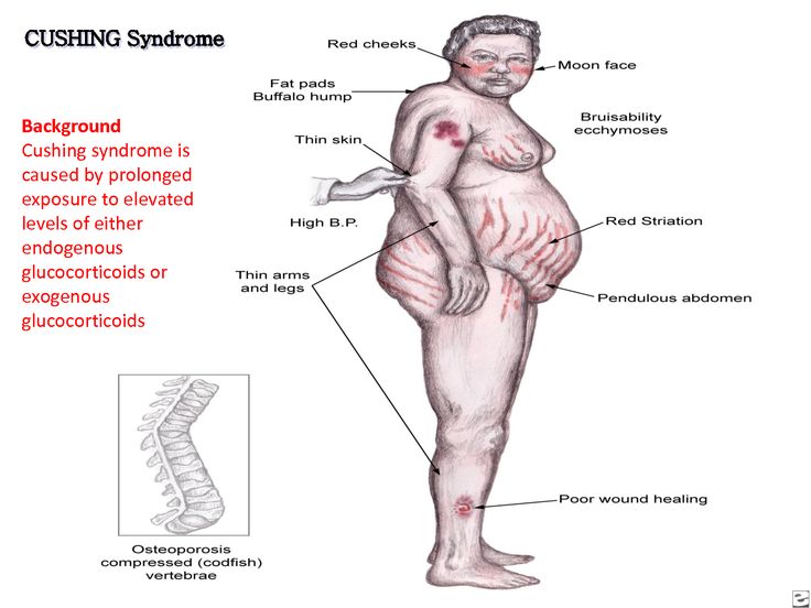 Cushing Syndrome: Causes, Symptoms & Treatment