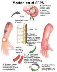 Acupuncture for Regional Pain Syndrome