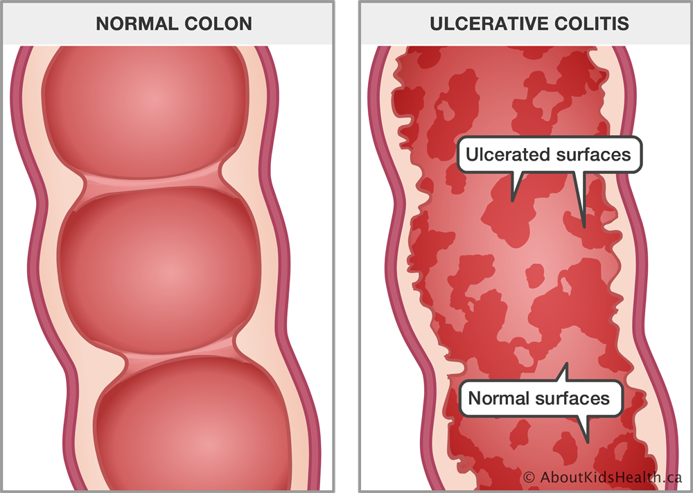Ulcerative colitis homeopathic treatment