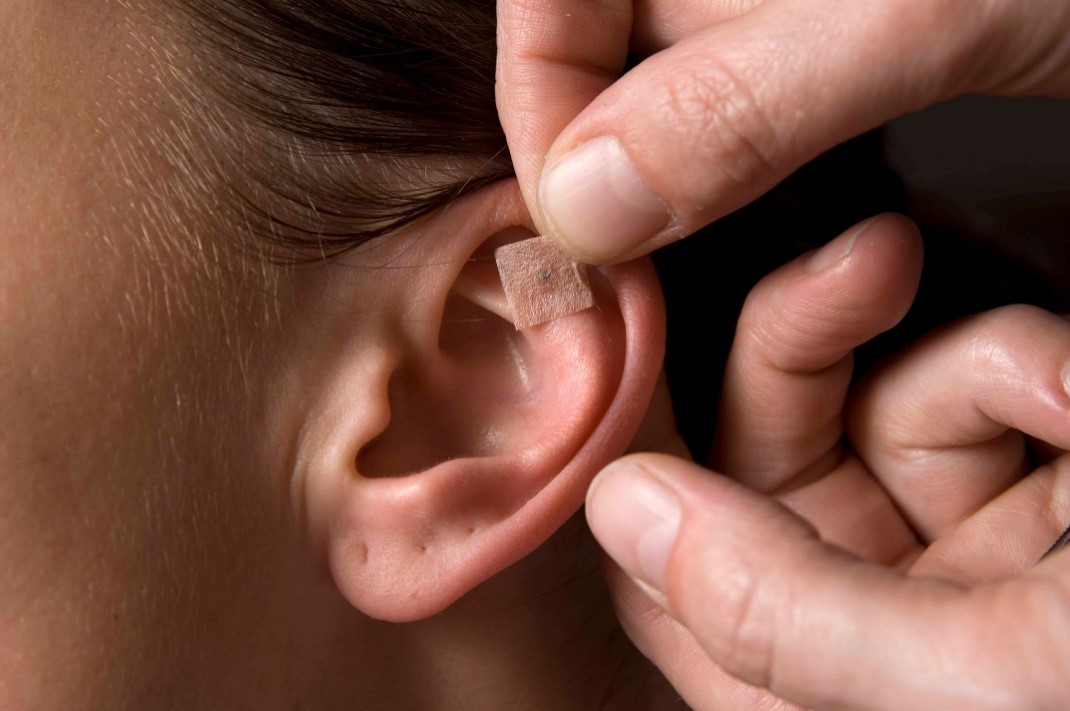 Auricular Acupuncture press needles