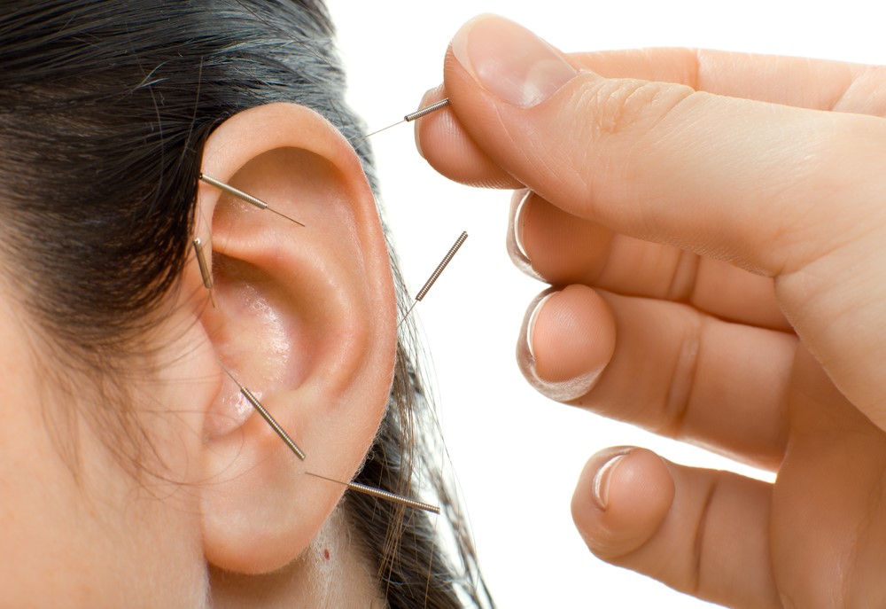 Auricular acupuncture long needles