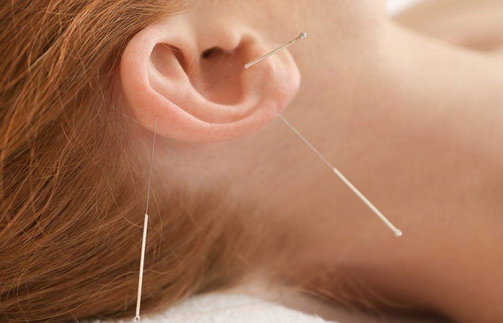 Auricular acupuncture procedure