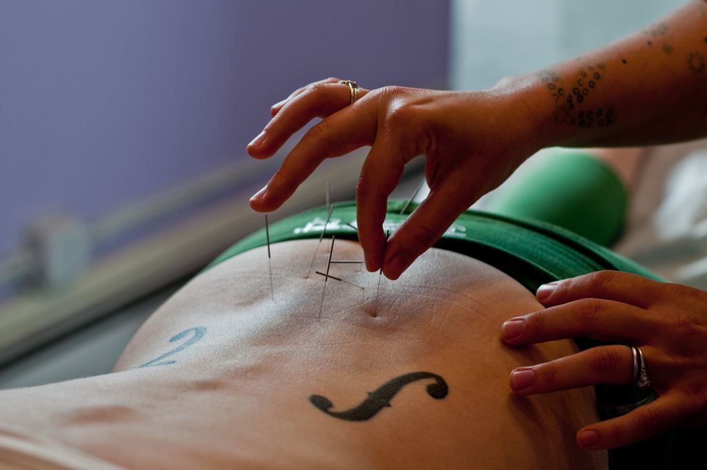 Acupuncture for sciatica 