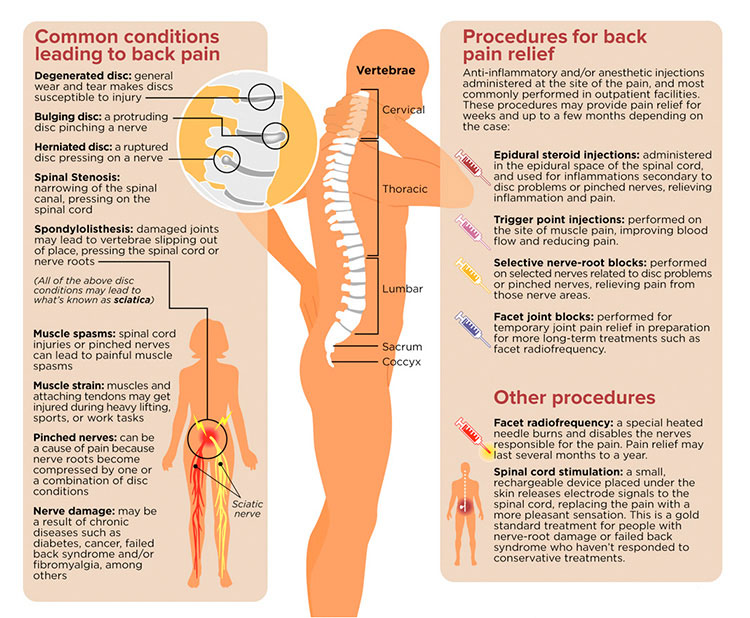 Back Pain Causes and Treatments