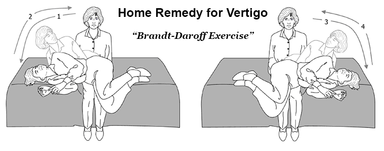 Brandt-Daroff exercise for vertigo