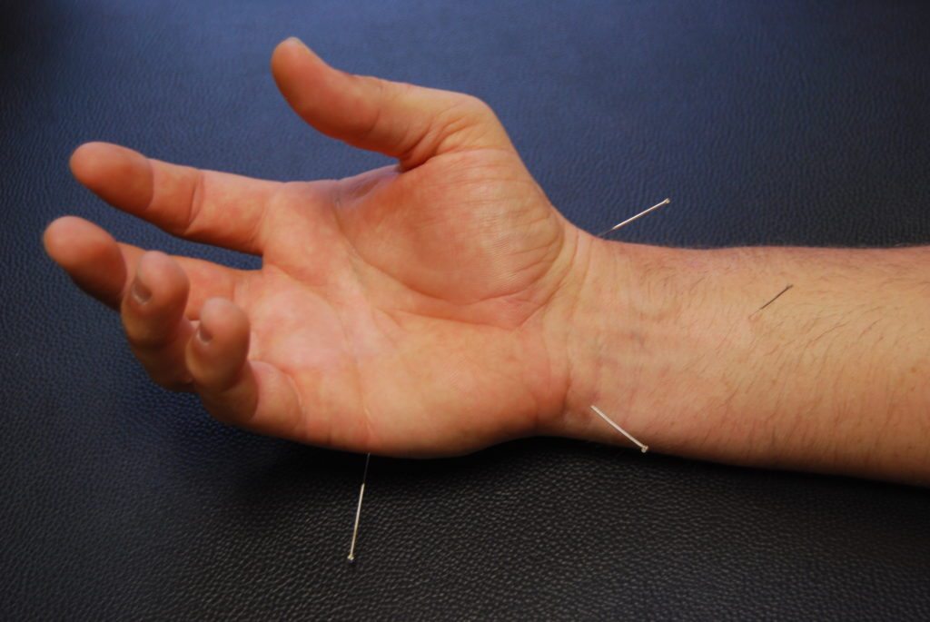 Acupuncture