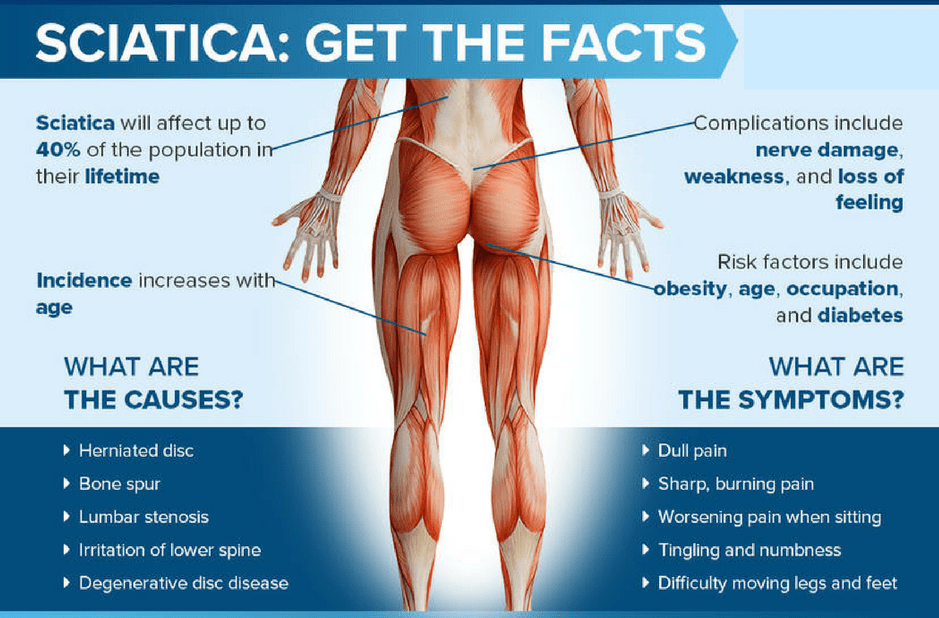 Facts about Sciatica