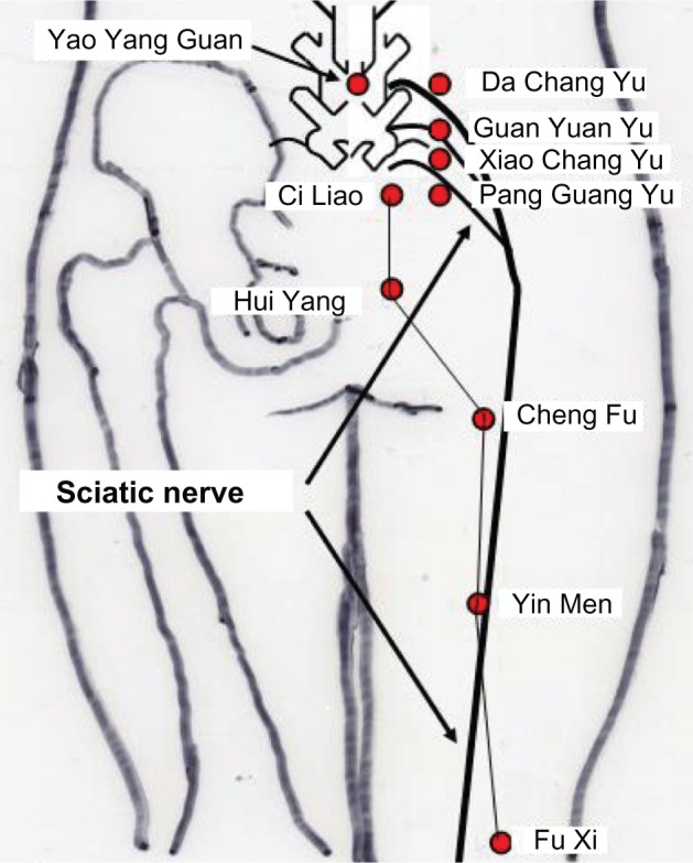 Acupuncture for sciatica 