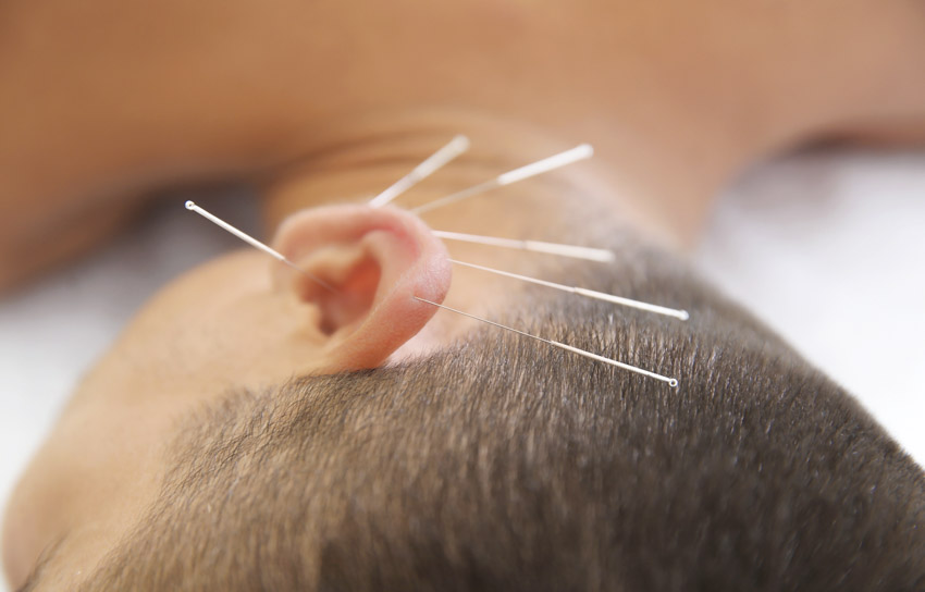 Vertigo acupuncture