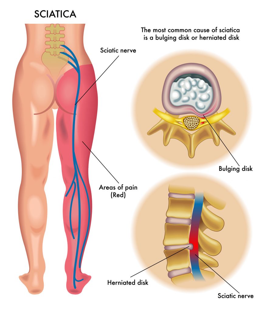 nerve-pain