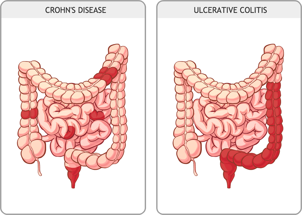 What is crohn's disease