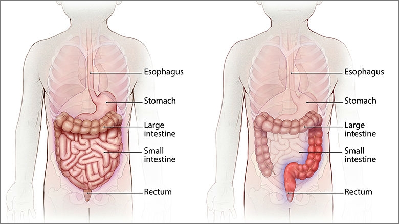 What is ulcerative colitis