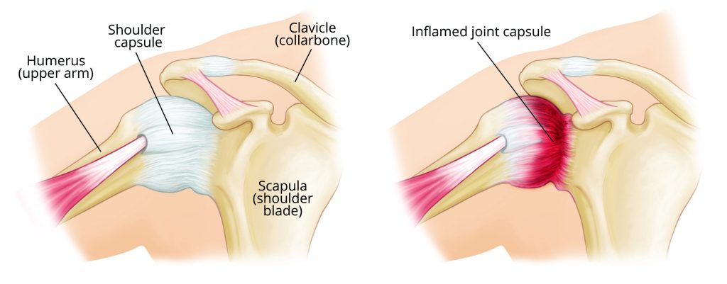 frozen shoulder couses
