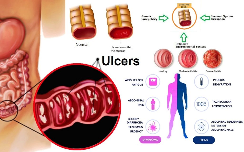 UC symptoms