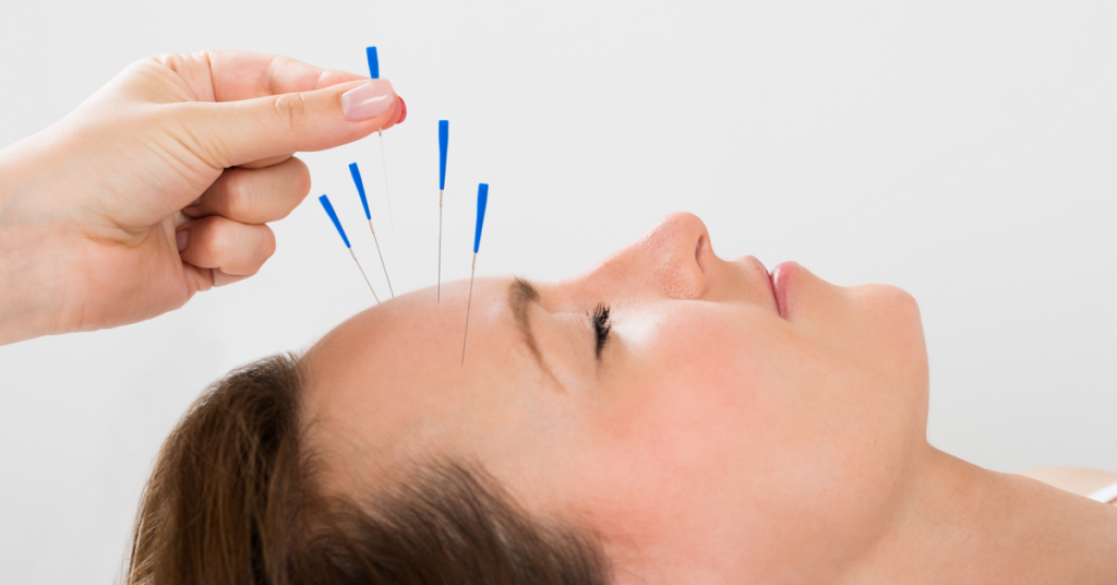 acupuncture