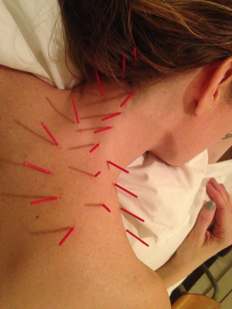 Acupuncture for neck pain