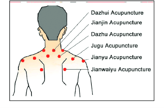 Neck Pain Acupuncture