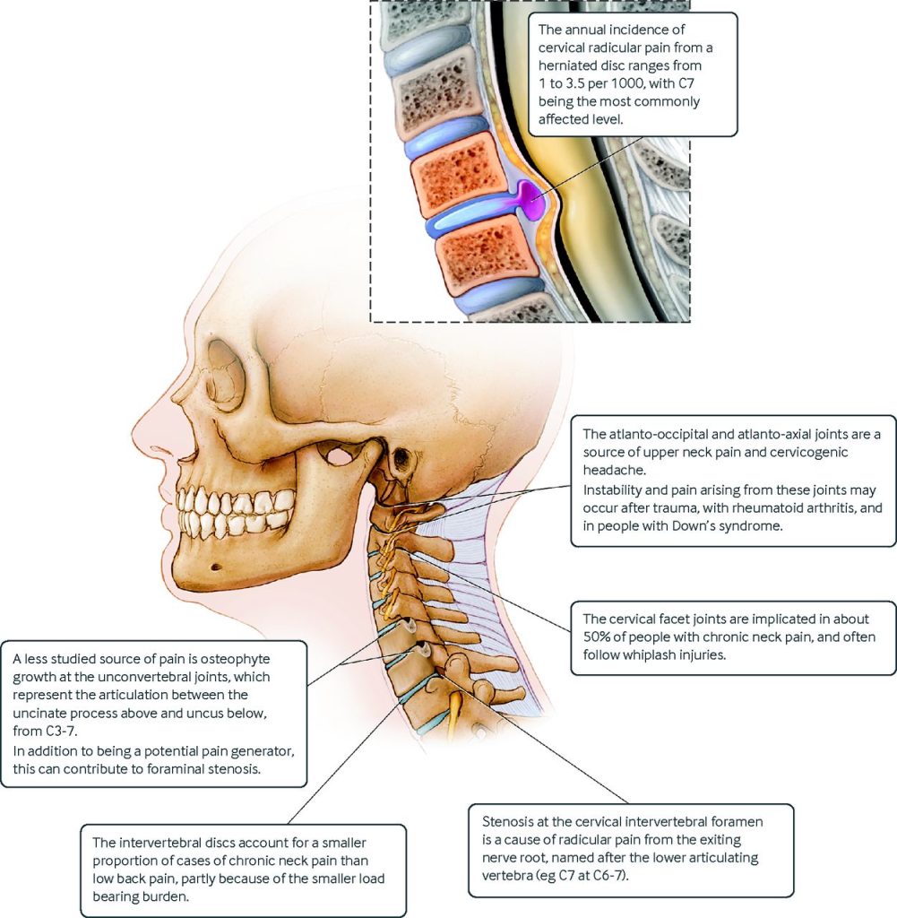 Neck Pain Diagnosis