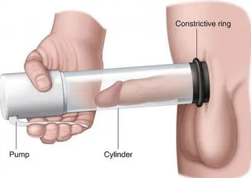 Vacuum Devise for Erectile Dysfunction Treatments
