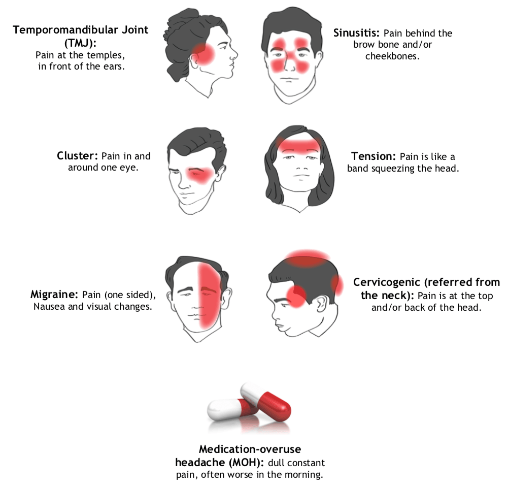 types of migraines