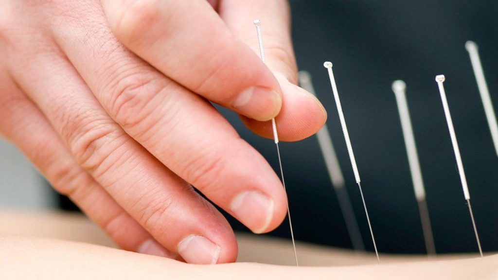 Acupuncture