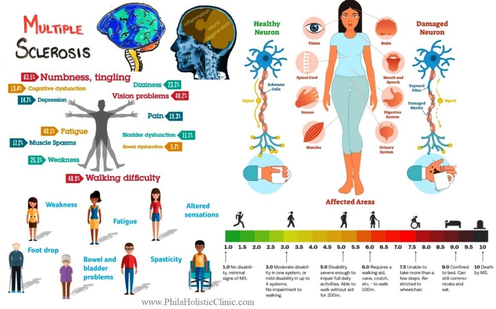 Homeopathic-treatment for Multipple Sclerosis