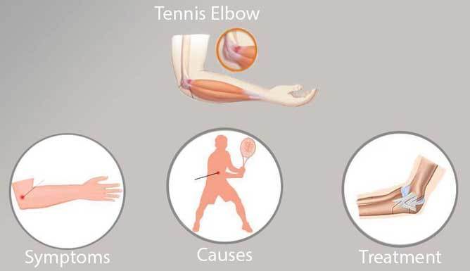 Tennis Elbow causes symptoms treatment