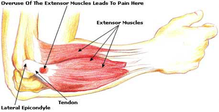 Tennis Elbow causes