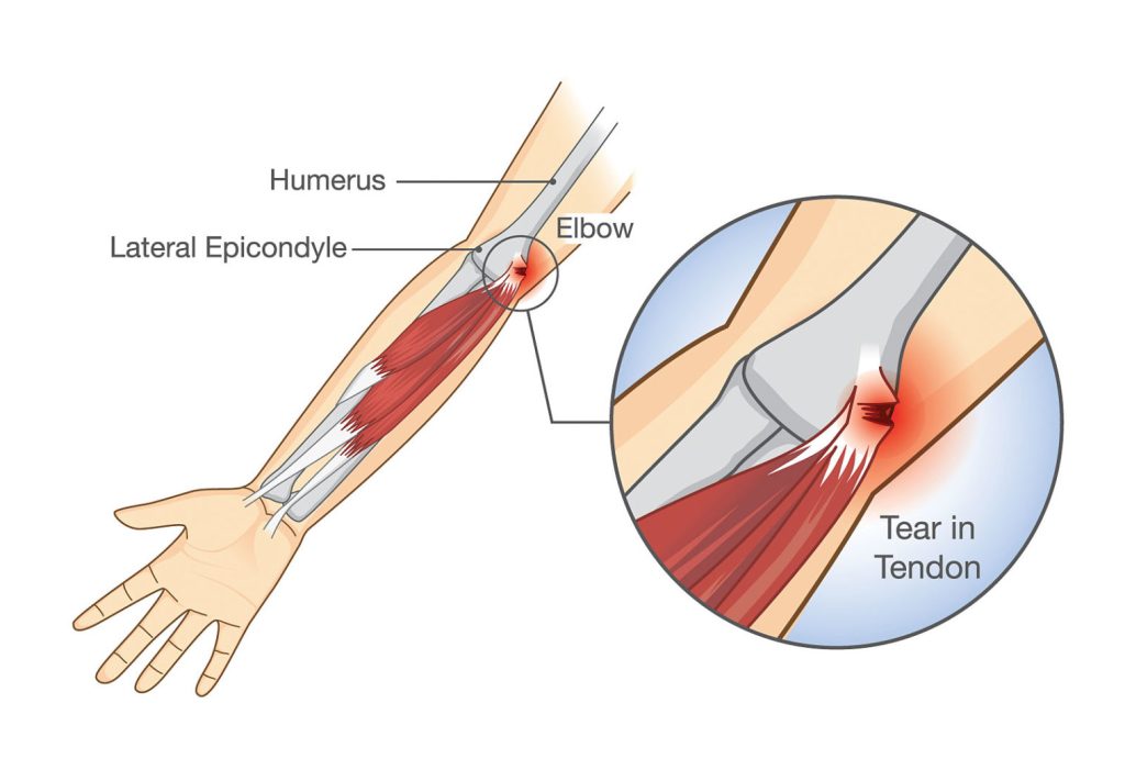 Lateral tendenitis