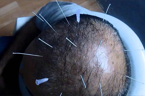Alopecia Acupuncture
