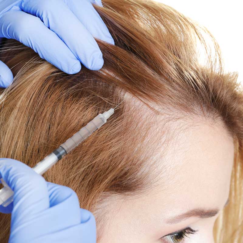 Alopecia - treatment