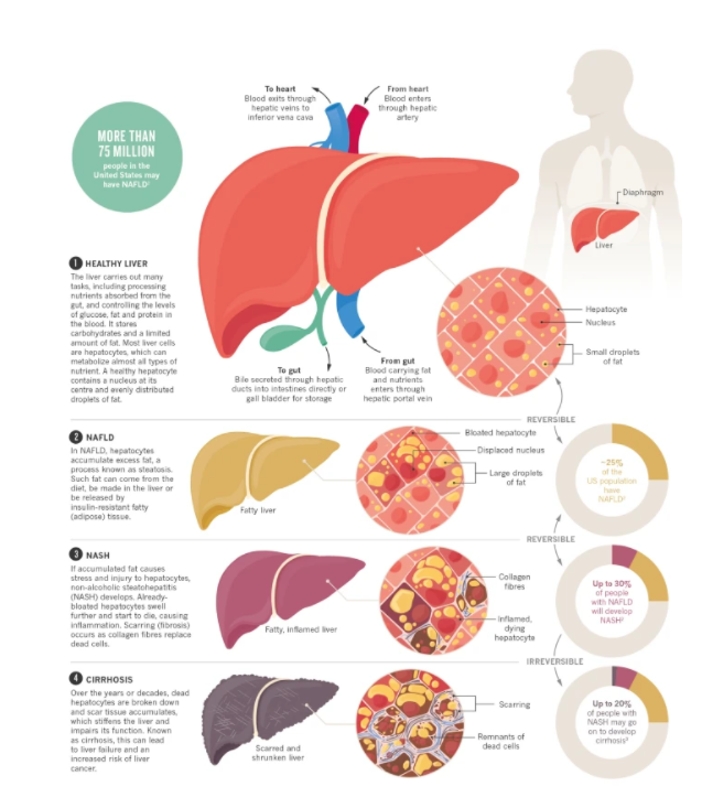 Fatty Liver
