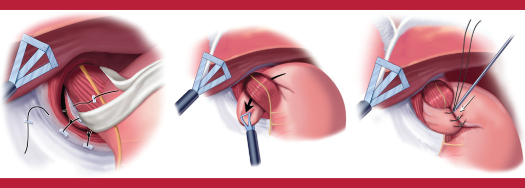 GERD surgery