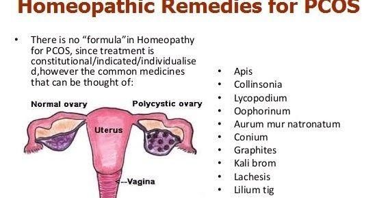 Homeopathy for PCOS