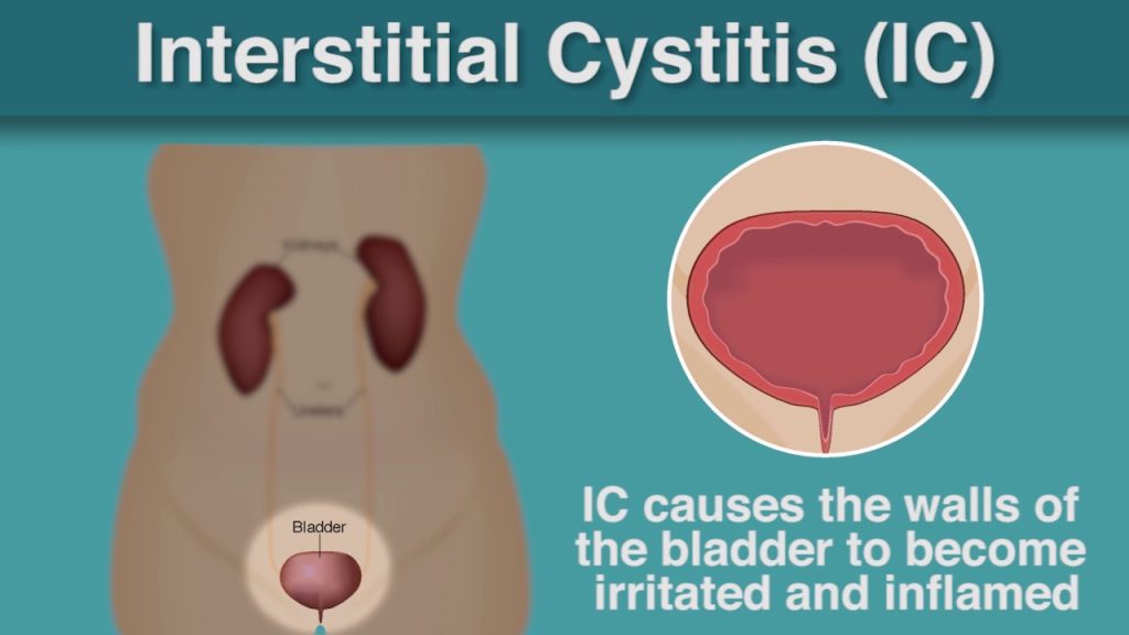 Intersitial Cystitis