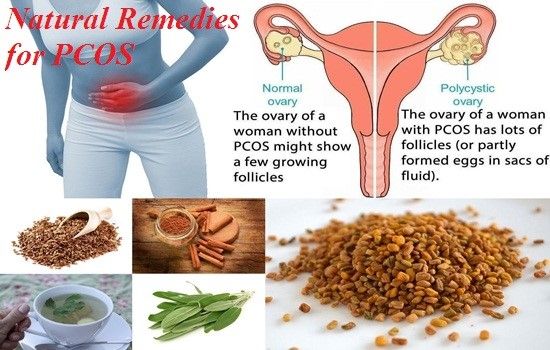 PCOS - Natural Treatment